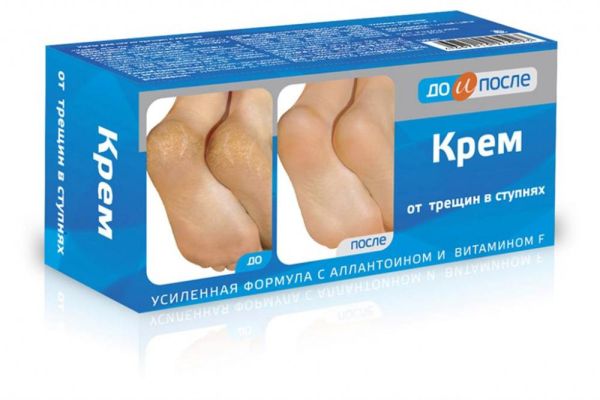 Изображение товара До и после крем от трещин в ступнях 50мл До и после крем от трещин в ступнях 50мл фотография